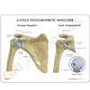 4-Stage Osteoarthritis Shoulder Anatomy Model - education cards