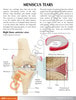 Knee with Meniscus Tears - back