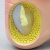 Foot with Gout Anatomy Model