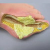 Foot with Gout Anatomy Model