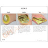 Foot with Gout Anatomy Model - back