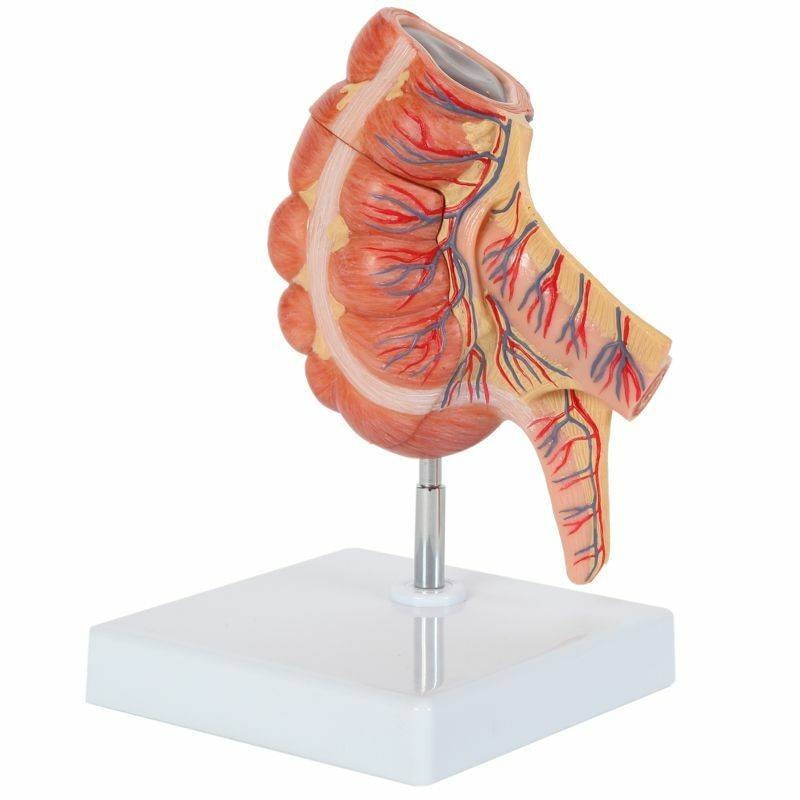 GPI Anatomicals Colon Anatomy Model With Pathologies | Anatomy Warehouse