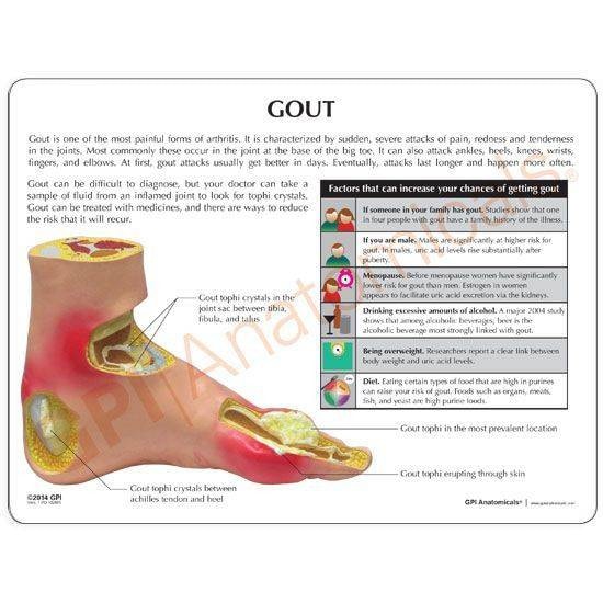Gout In Painful Heel Syndrome Gout Pain Under The Heel Of Foot