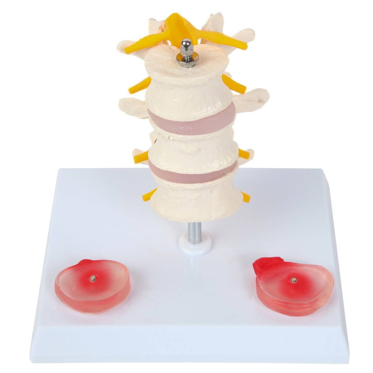 Axis Scientific Lumbar Vertebrae with Prolapsed Discs