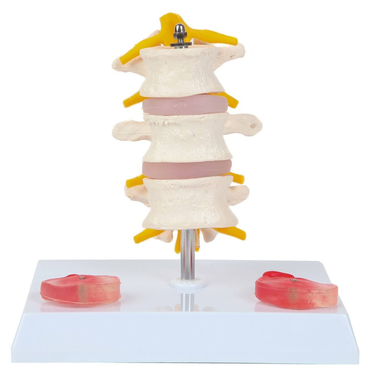 Axis Scientific Lumbar Vertebrae with Prolapsed Discs | Anatomy