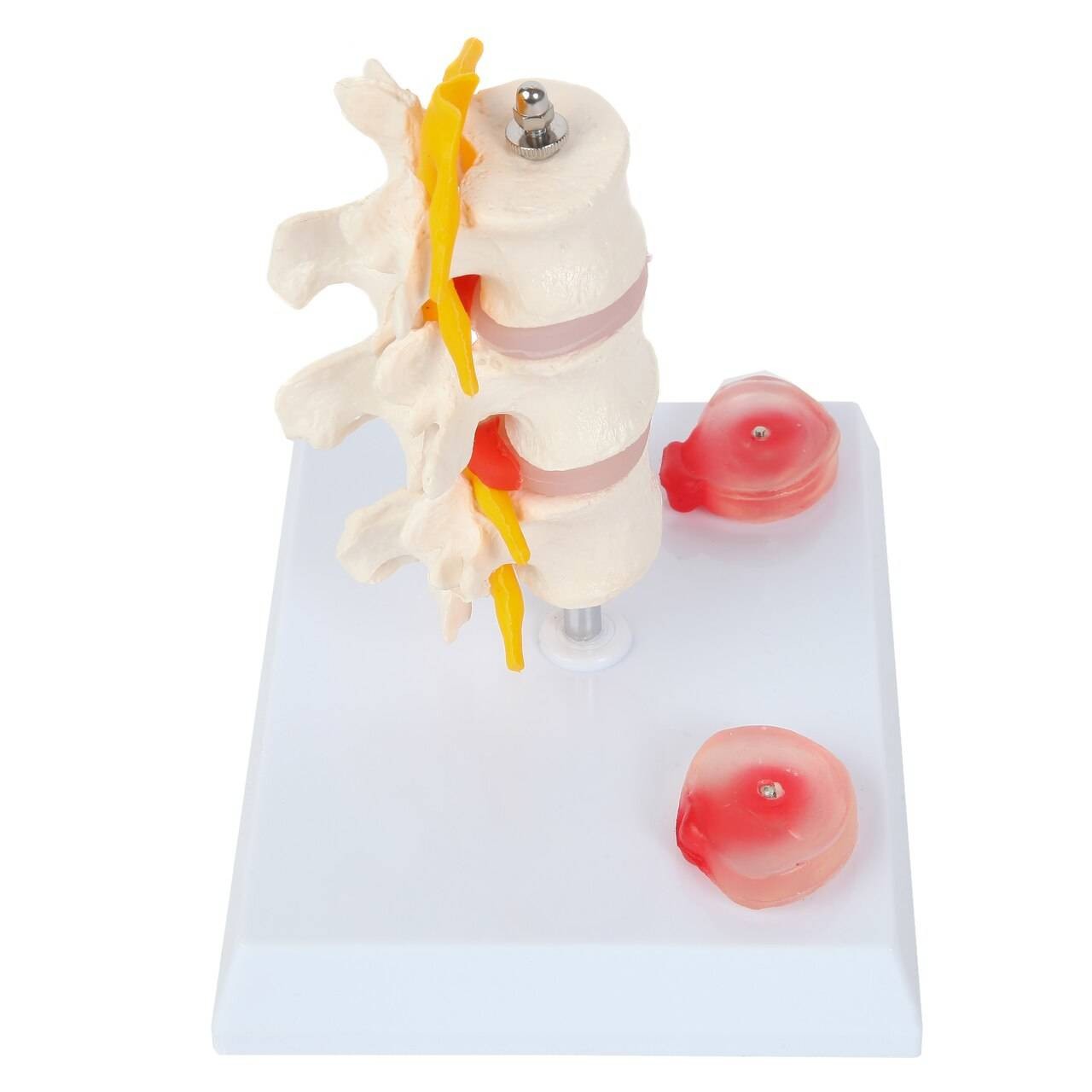Axis Scientific Lumbar Vertebrae with Prolapsed Discs | Anatomy