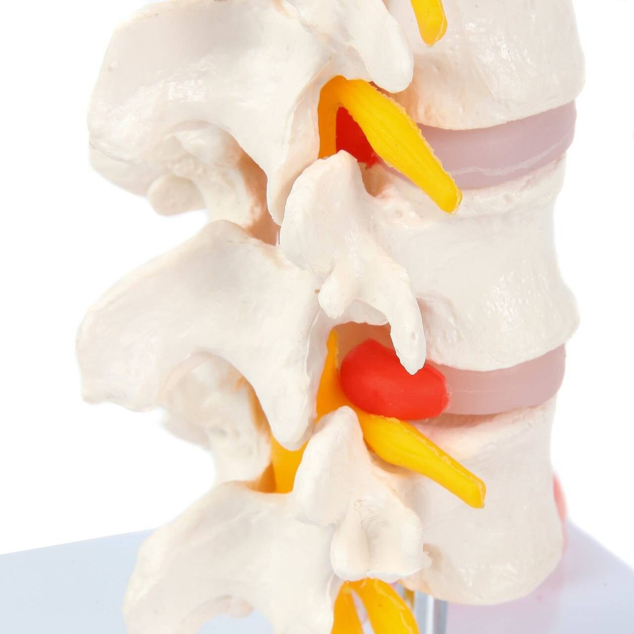 Axis Scientific Lumbar Vertebrae with Prolapsed Discs