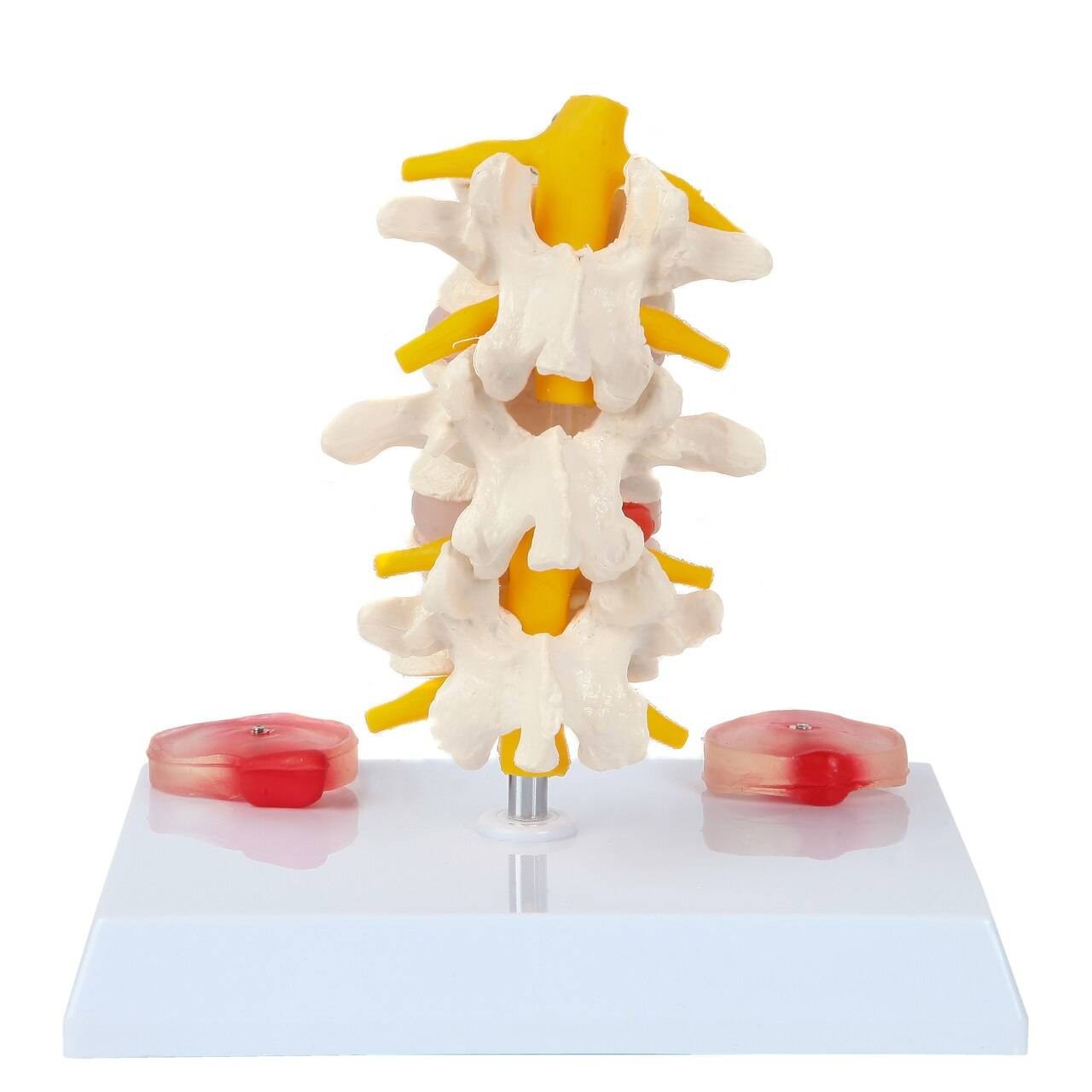Axis Scientific Lumbar Vertebrae with Prolapsed Discs | Anatomy