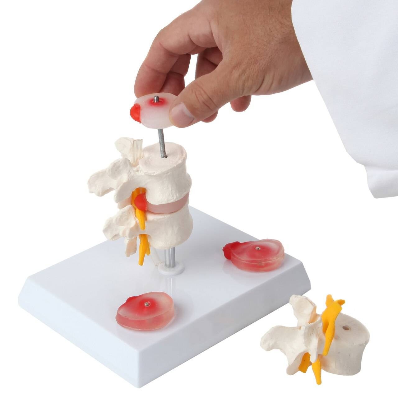 Axis Scientific Lumbar Vertebrae with Prolapsed Discs | Anatomy