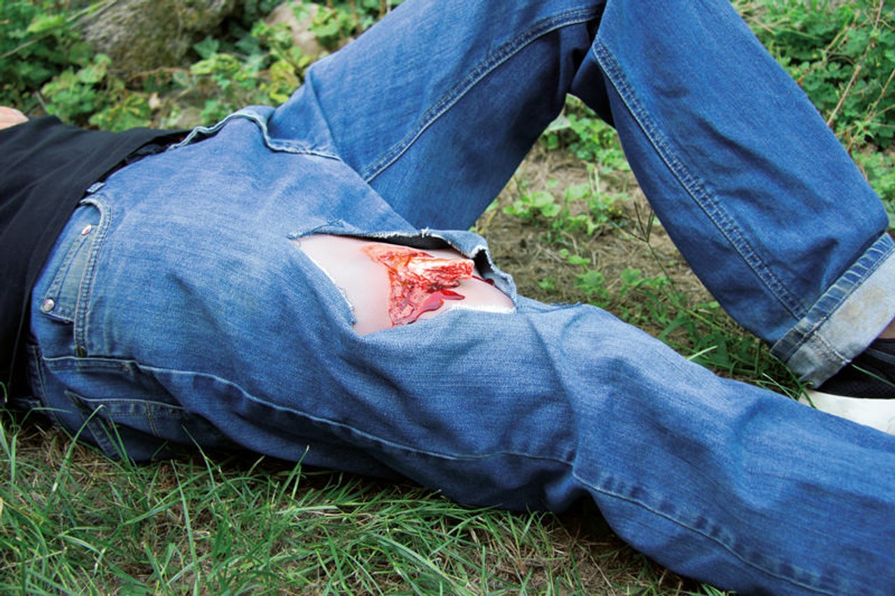 Leg Skin Moulage, Open Fracture Wound - Bleeding