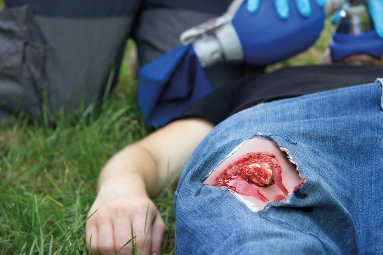 Leg Skin Moulage, Open Fracture Wound - Bleeding