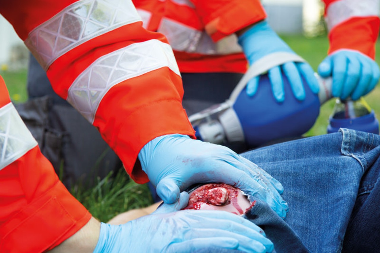Leg Skin Moulage, Open Fracture Wound - Bleeding