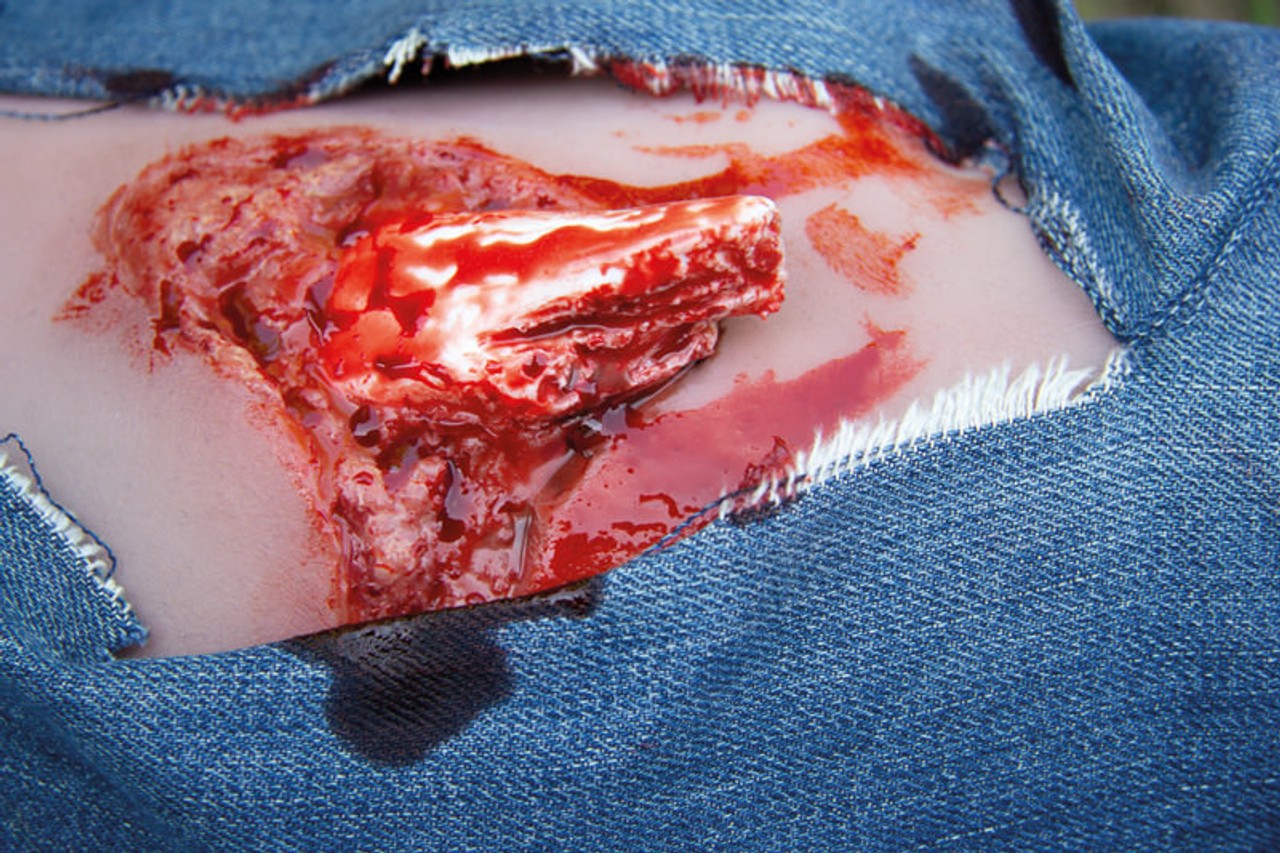 Leg Skin Moulage, Open Fracture Wound - Bleeding