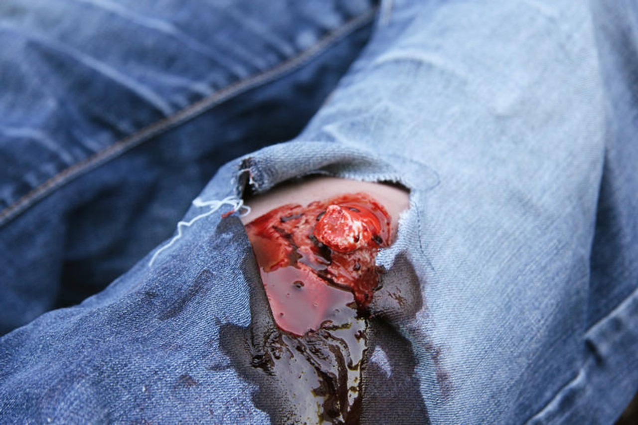 Leg Skin Moulage, Open Fracture Wound - Bleeding