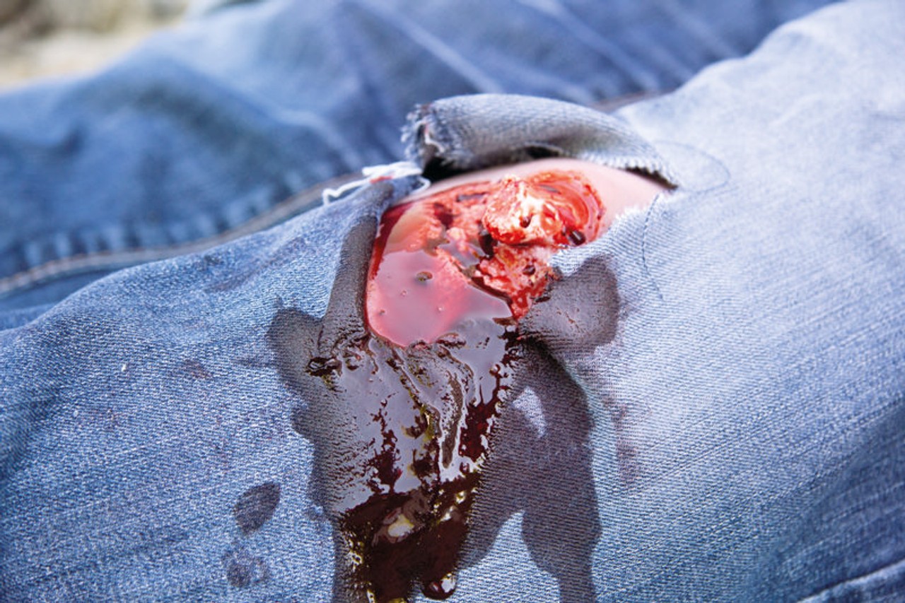 Leg Skin Moulage, Open Fracture Wound - Bleeding
