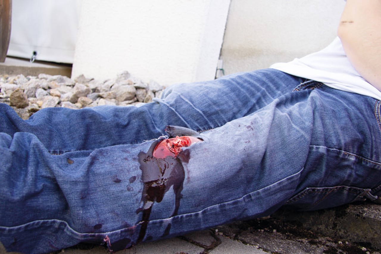 Leg Skin Moulage, Open Fracture Wound - Bleeding