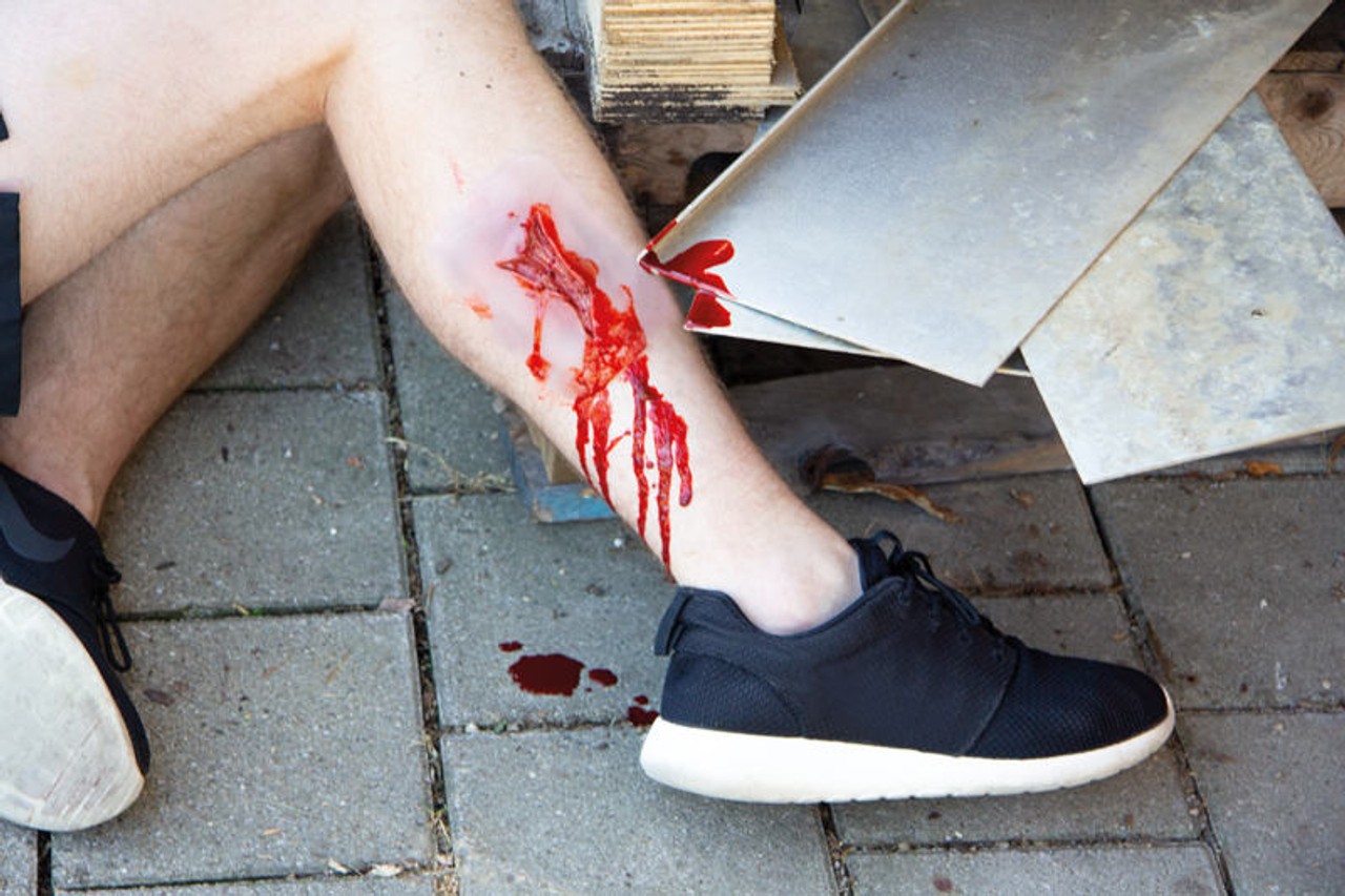 Skin Moulage, Laceration Wound