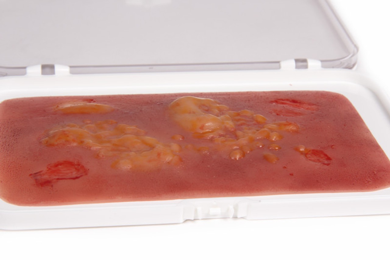 Skin Moulage, 2nd Degree Burn Wound