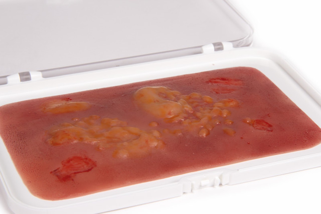 Skin Moulage, 2nd Degree Burn Wound