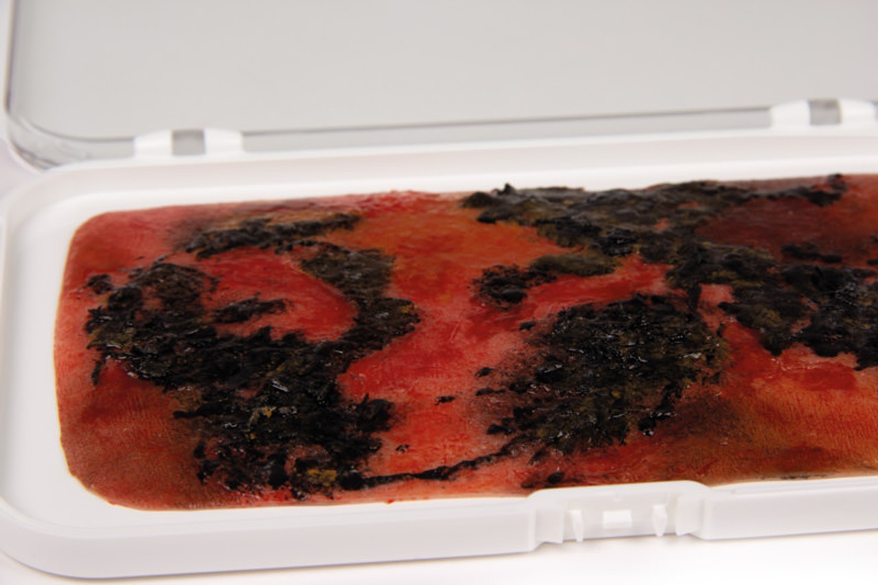Skin Moulage, 3rd Degree Burn Wound