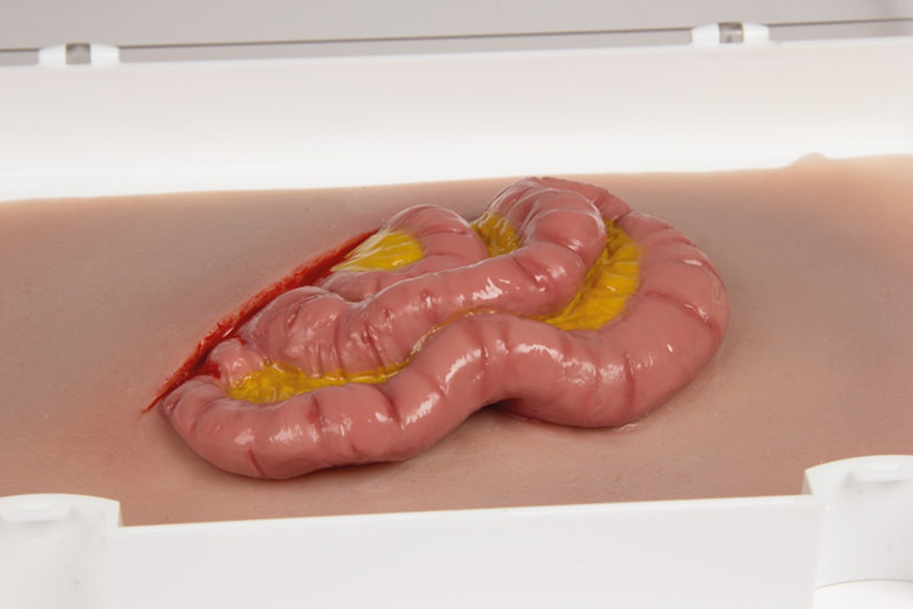 Skin Moulage, Protrusion of Small Intestines