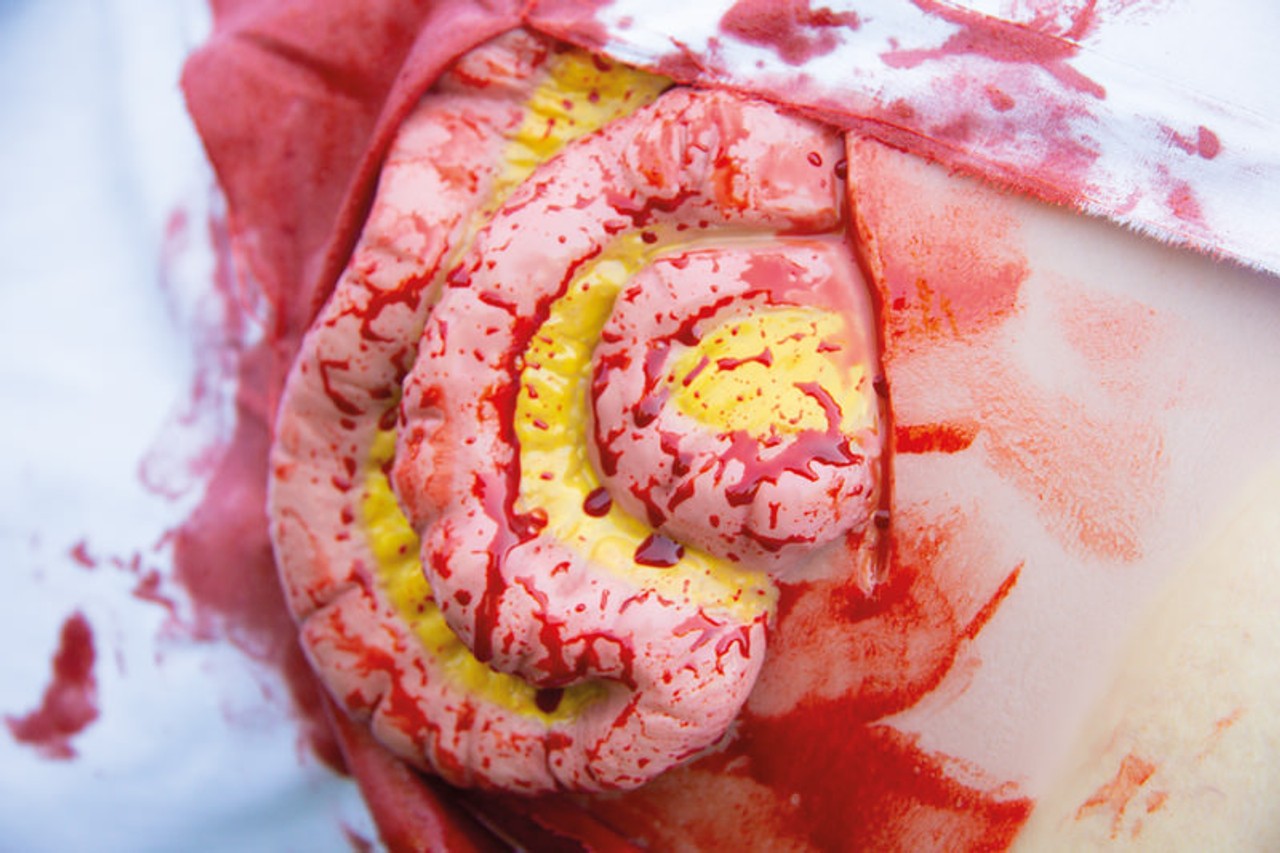 Skin Moulage, Protrusion of Small Intestines