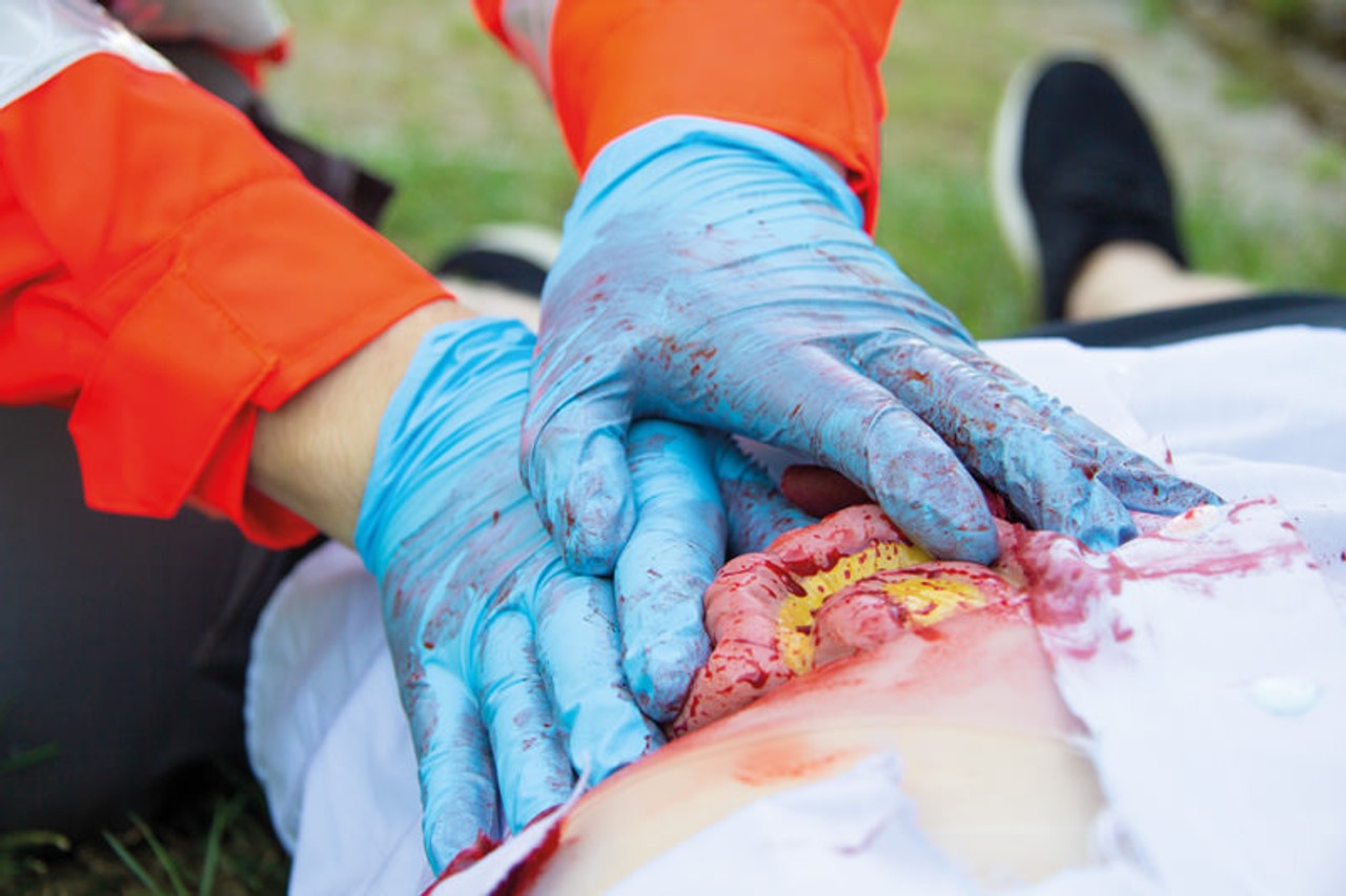 Skin Moulage, Protrusion of Small Intestines