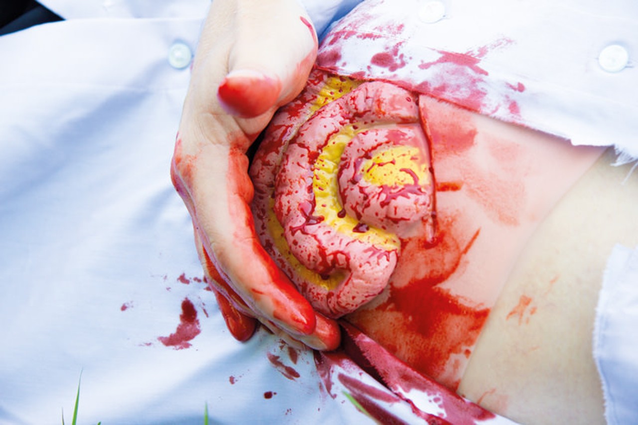 Skin Moulage, Protrusion of Small Intestines