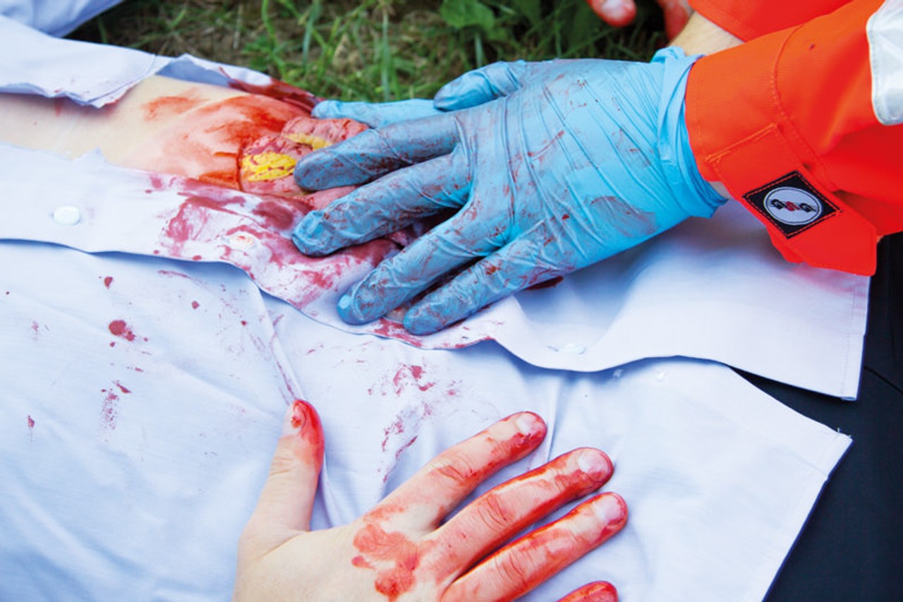 Skin Moulage, Protrusion of Small Intestines