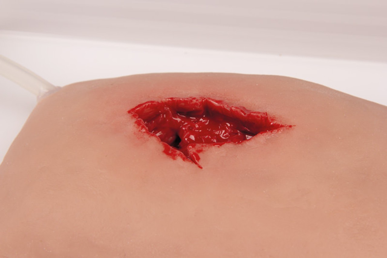 Large Wound Moulage for Wound Packing