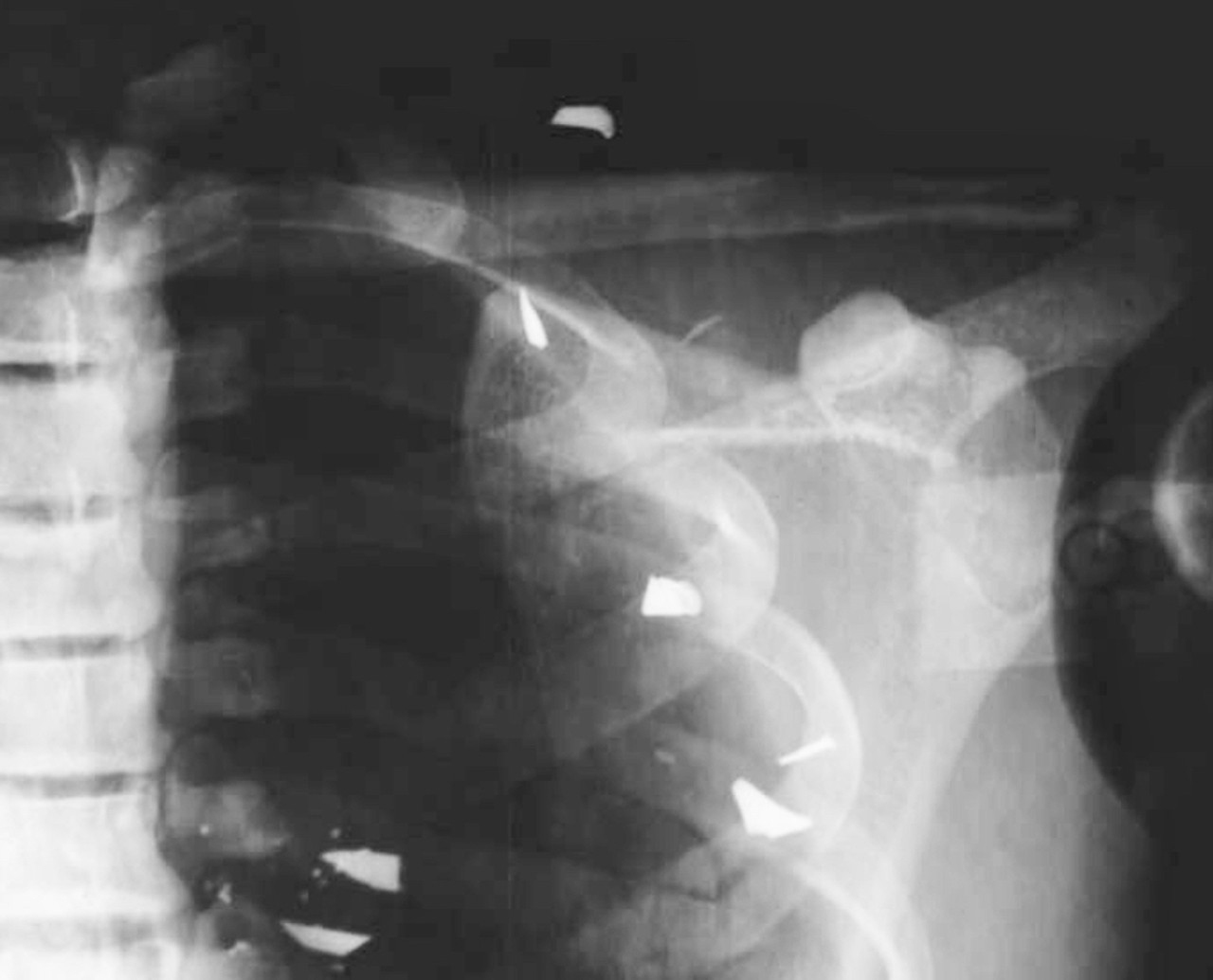 Damaged Debbie Anthropomorphic Body Phantom X-Ray of the Shoulder
