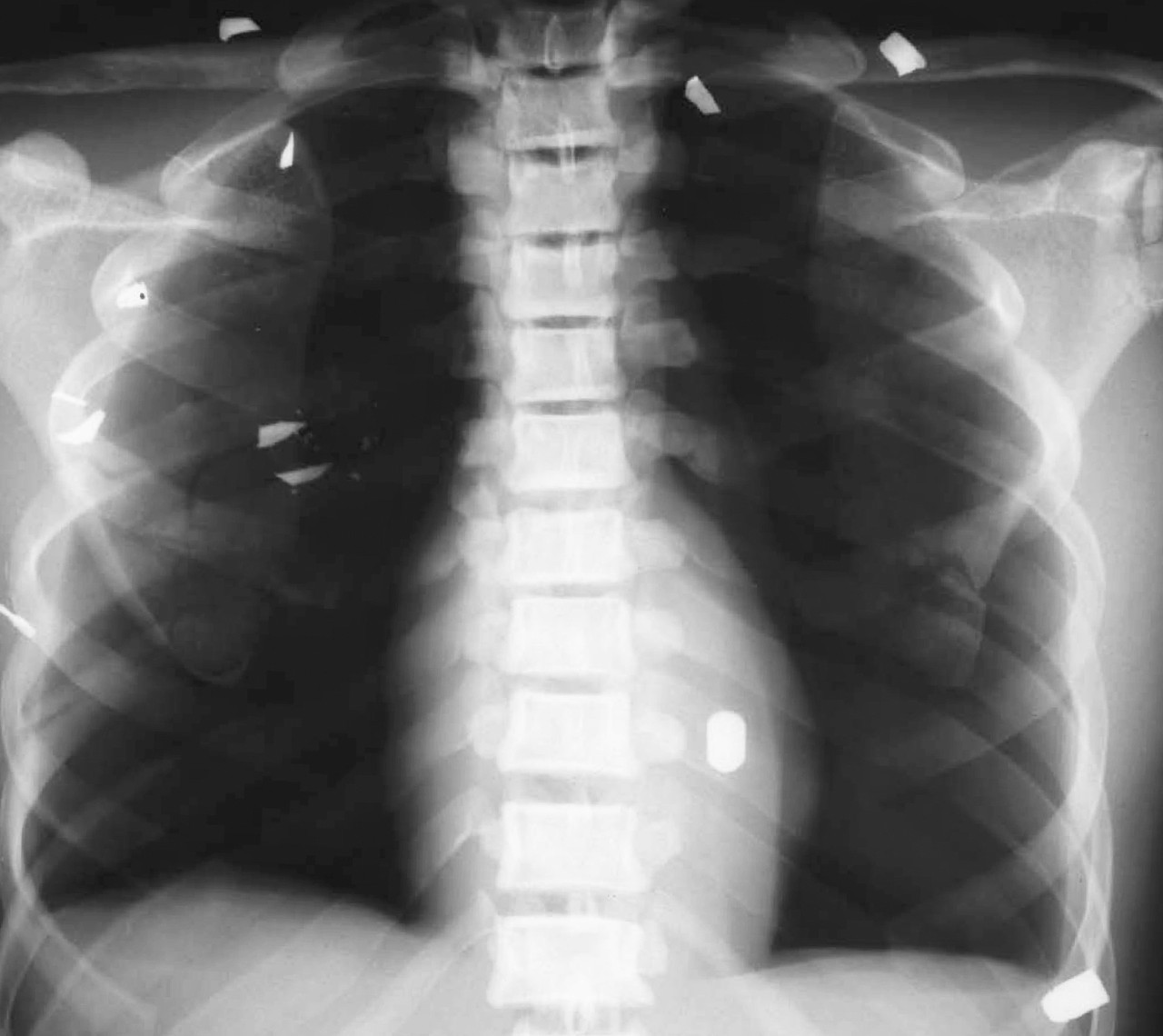 Damaged Debbie Anthropomorphic Body Phantom X-Ray of the Ribcage