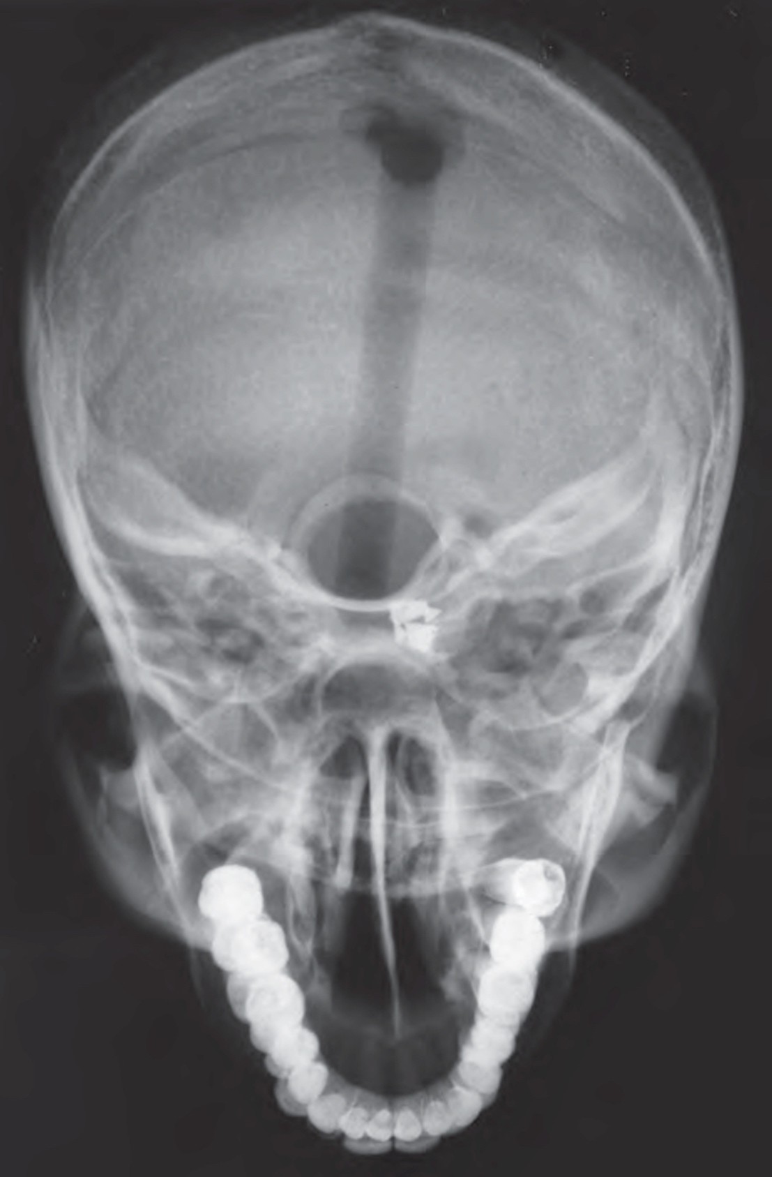 Damaged Debbie Anthropomorphic Body Phantom X-Ray of the Skull