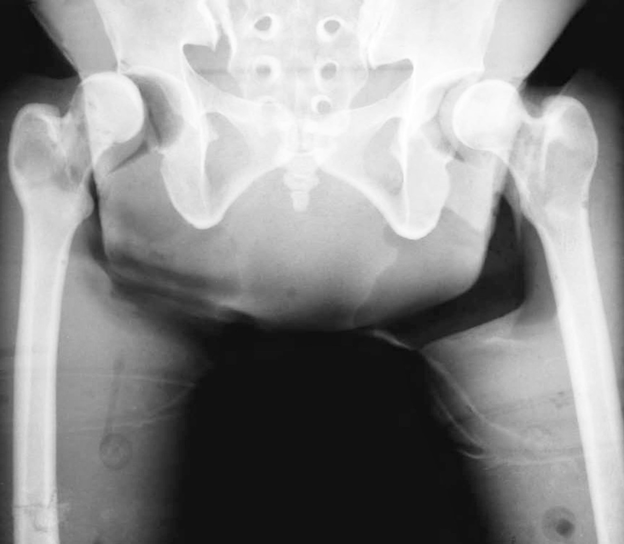 Damaged Debbie Anthropomorphic Body Phantom X-Ray of the Pelvis