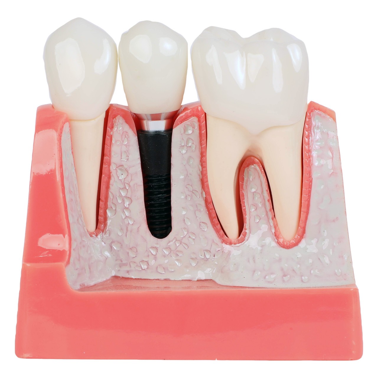健康・医学 Implant Dentistry: Theory and Practice The Single-Tooth Implant | Dennis P. Tarnow / Stephen J. Chu