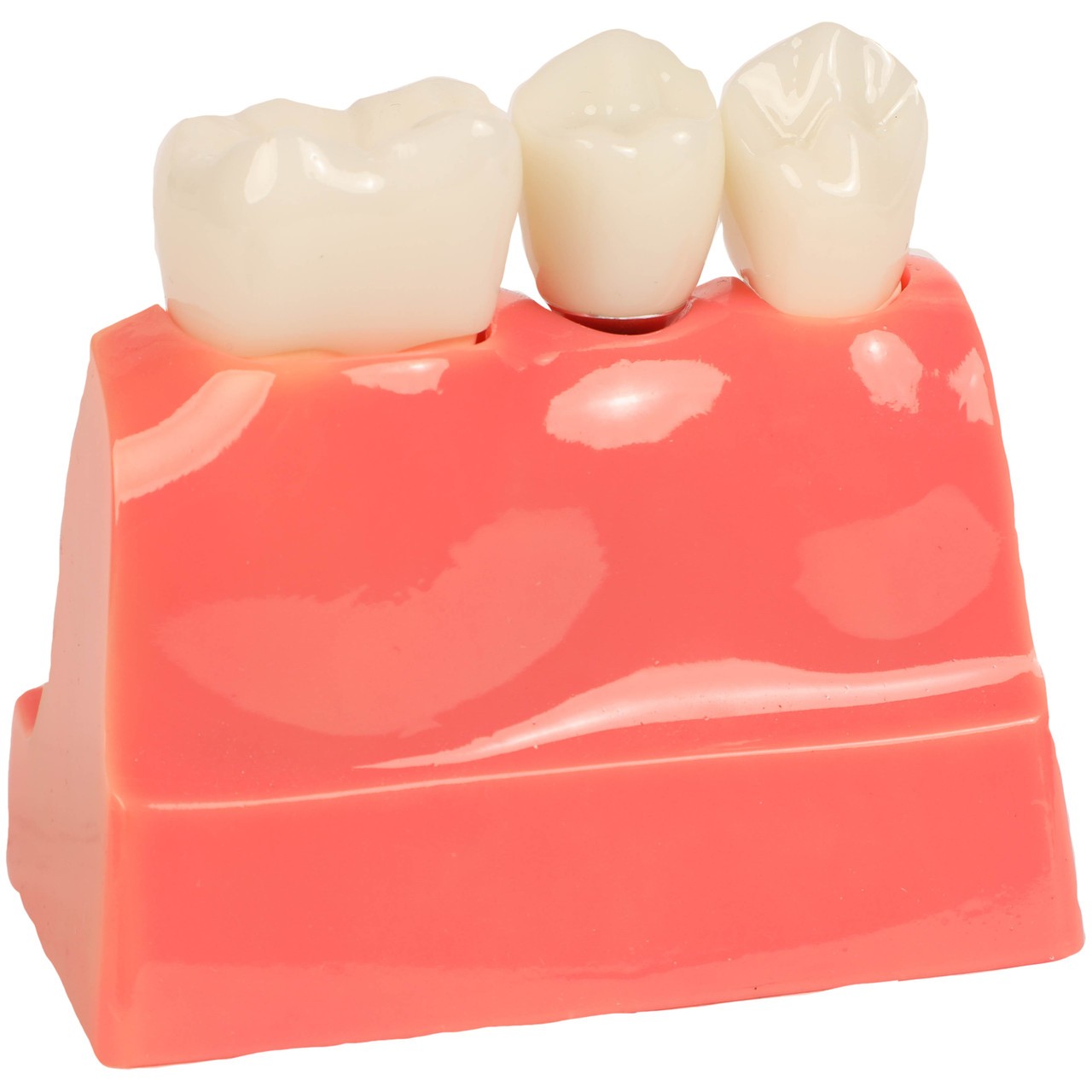 Axis Scientific Enlarged Dental Implant Anatomy Model