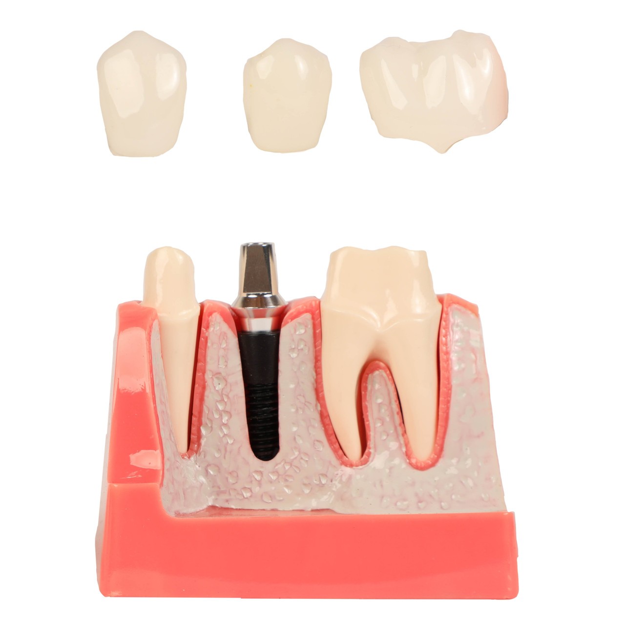 Axis Scientific Enlarged Dental Implant Anatomy Model