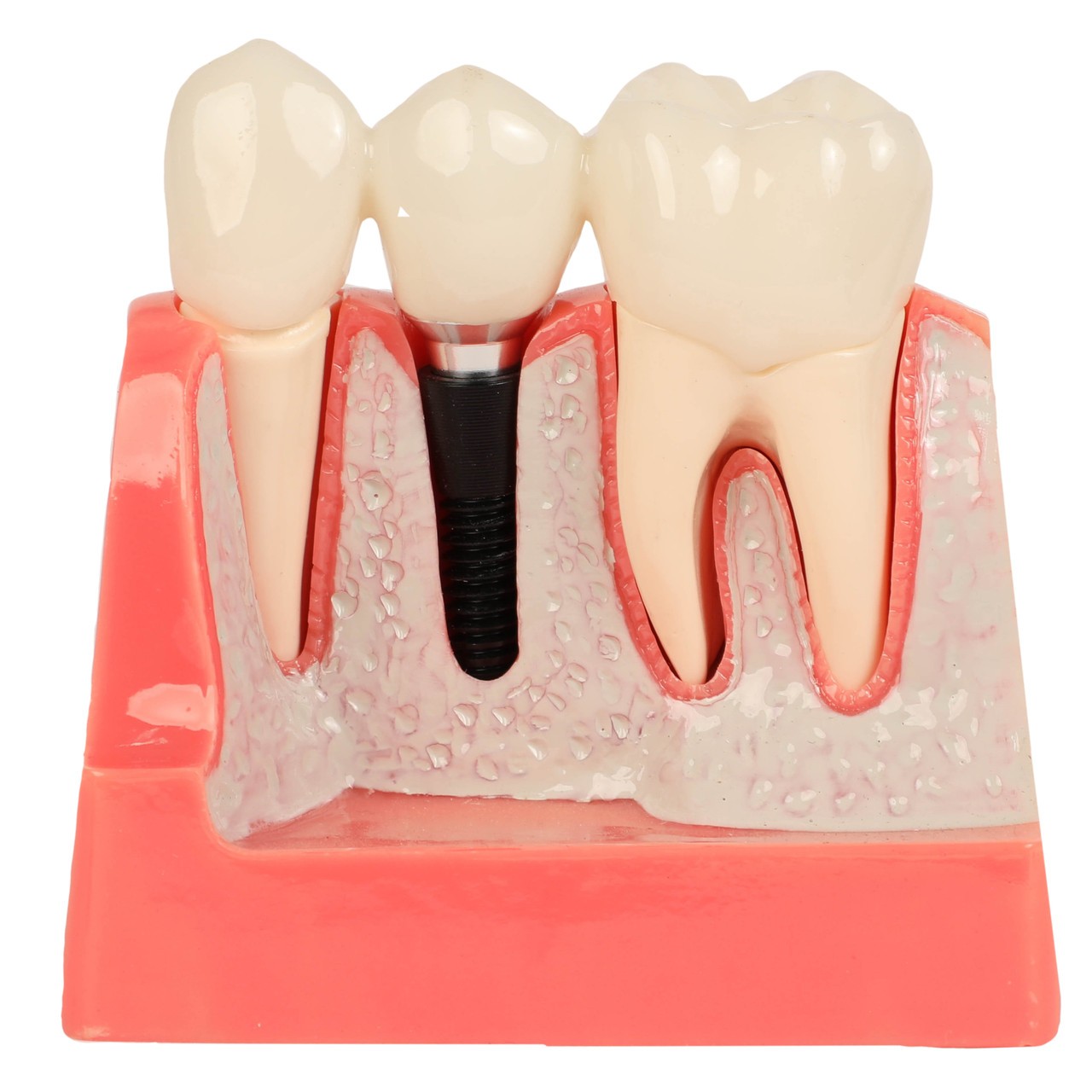 Axis Scientific Enlarged Dental Implant Anatomy Model