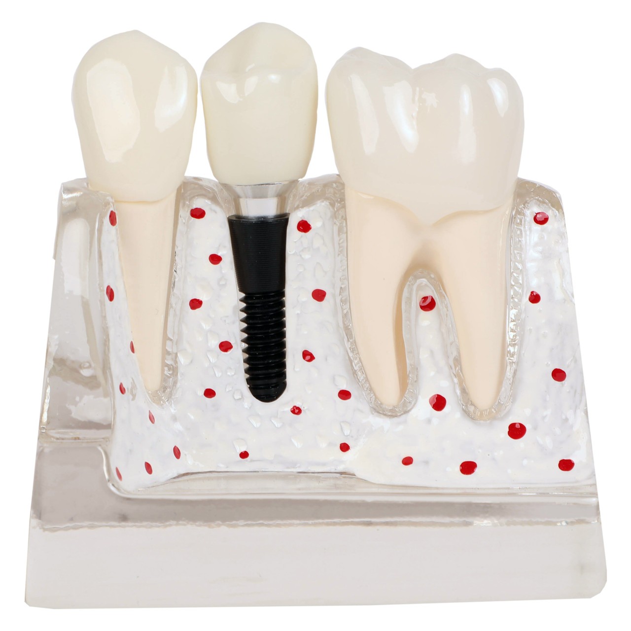 Axis Scientific Enlarged Transparent Dental Implant Anatomy Model