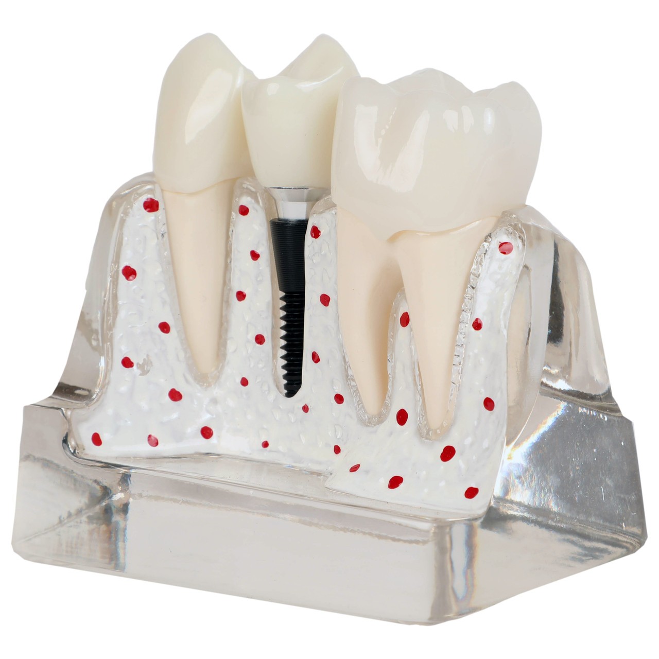 Axis Scientific Enlarged Transparent Dental Implant Anatomy Model