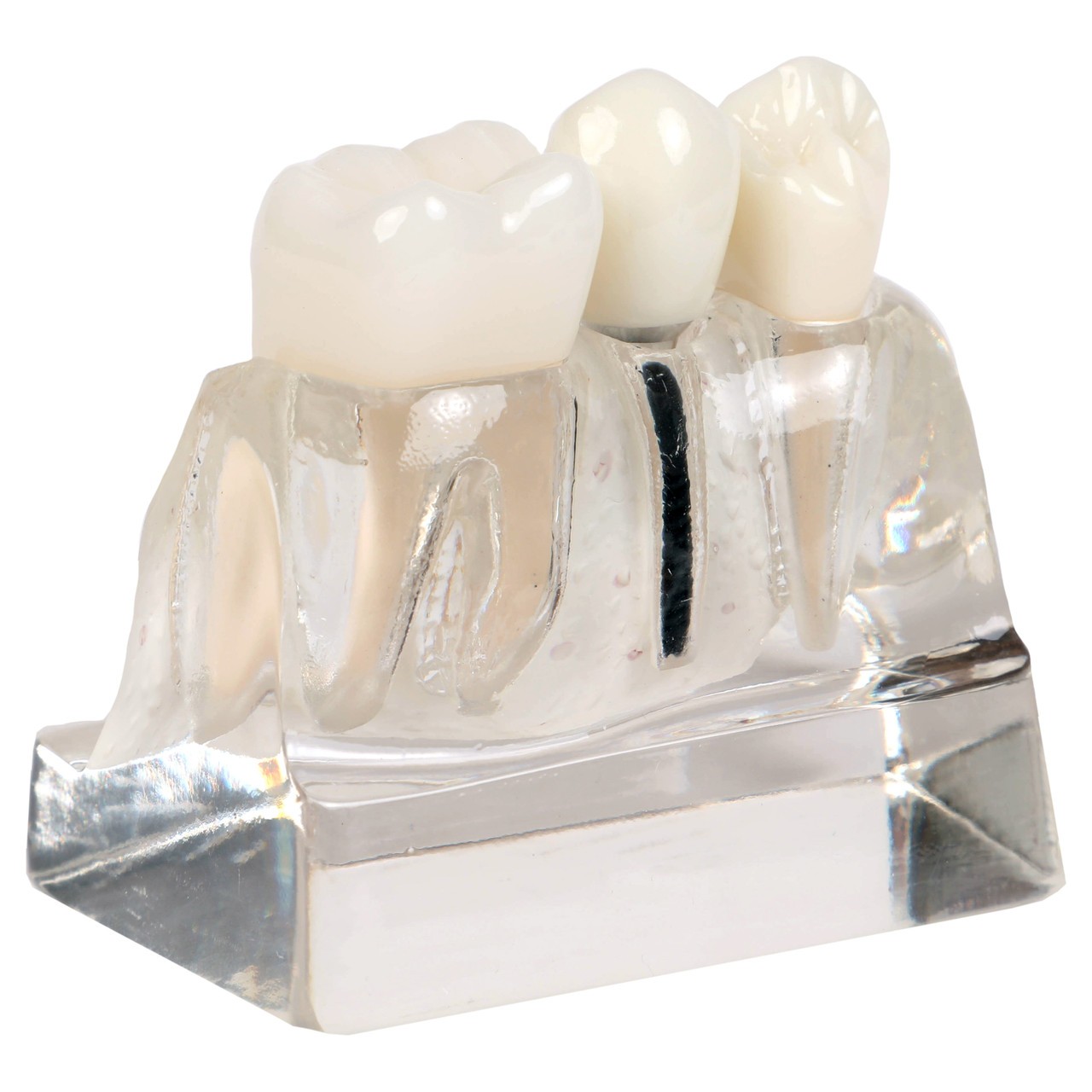 Axis Scientific Enlarged Transparent Dental Implant Anatomy Model