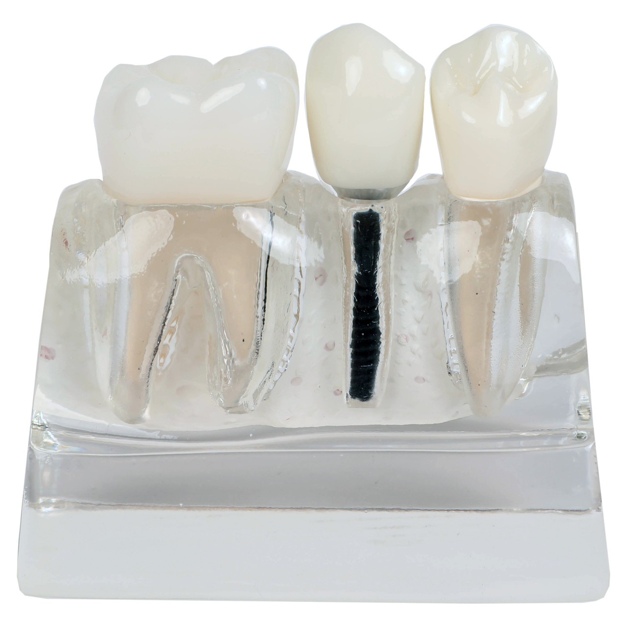 Axis Scientific Enlarged Transparent Dental Implant Anatomy Model