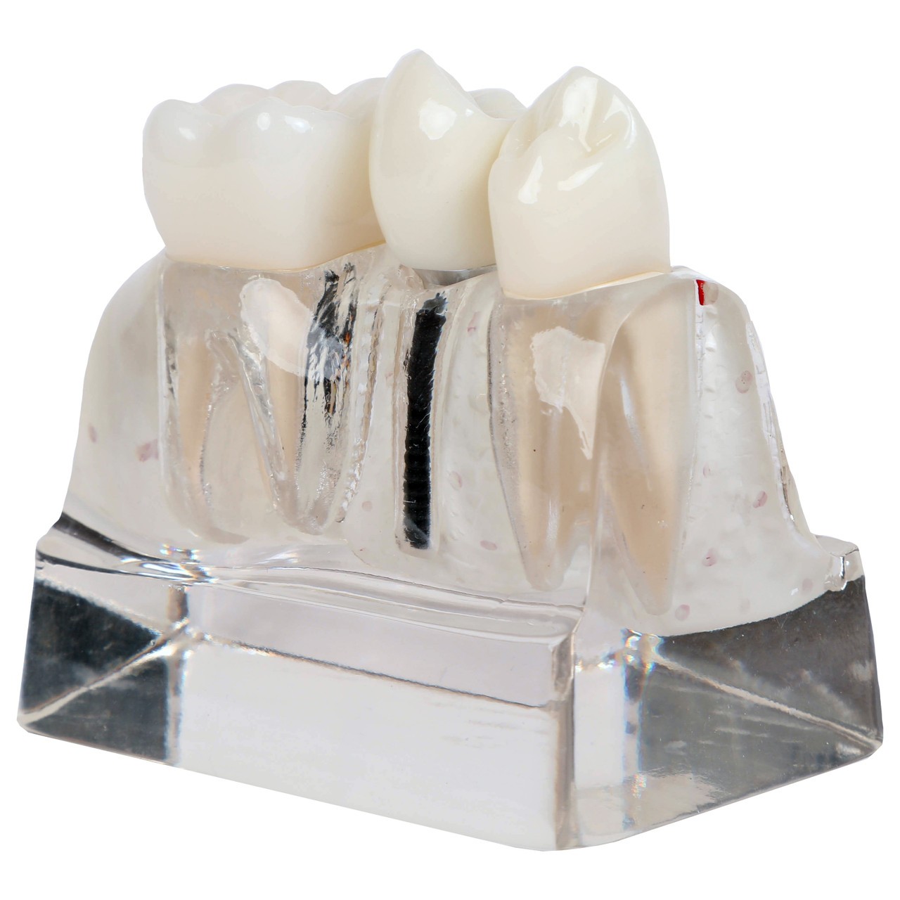 Axis Scientific Enlarged Transparent Dental Implant Anatomy Model