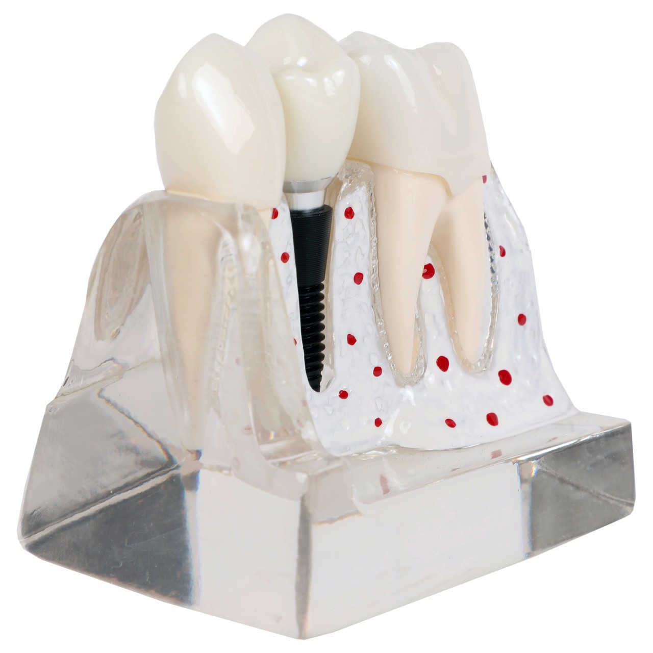 Axis Scientific Enlarged Transparent Dental Implant Anatomy Model