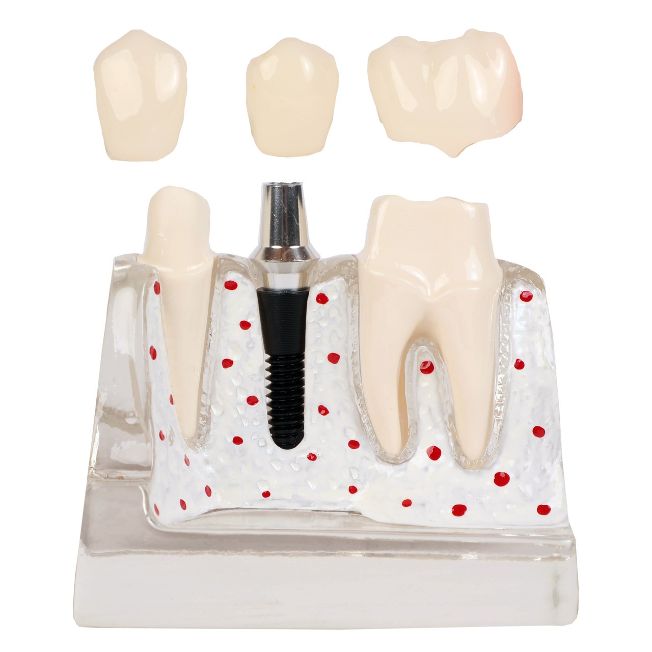 Axis Scientific Enlarged Transparent Dental Implant Anatomy Model