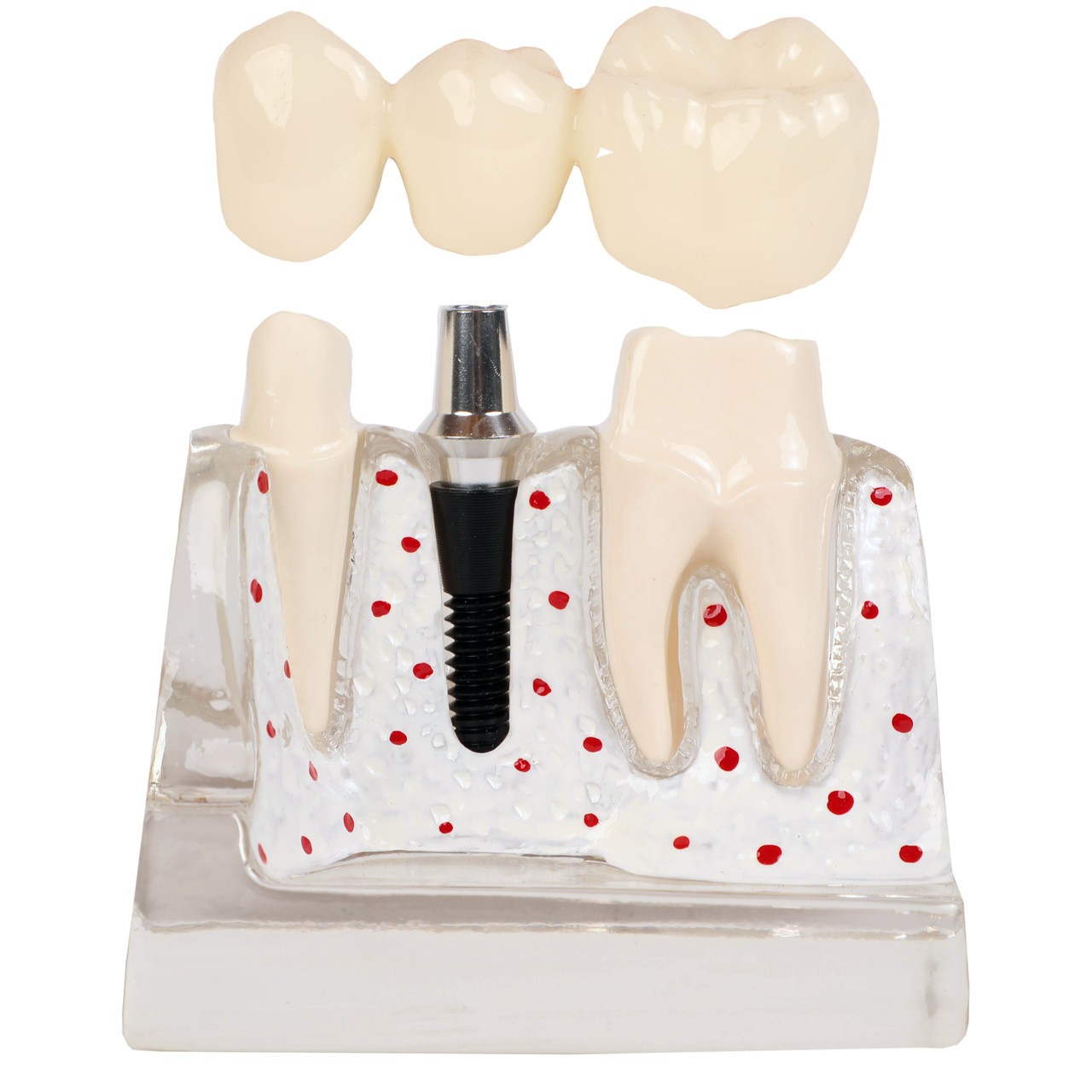 健康・医学 Implant Dentistry: Theory and Practice Dental 4 Times Implant Teeth Model Analysis Crown Bridge