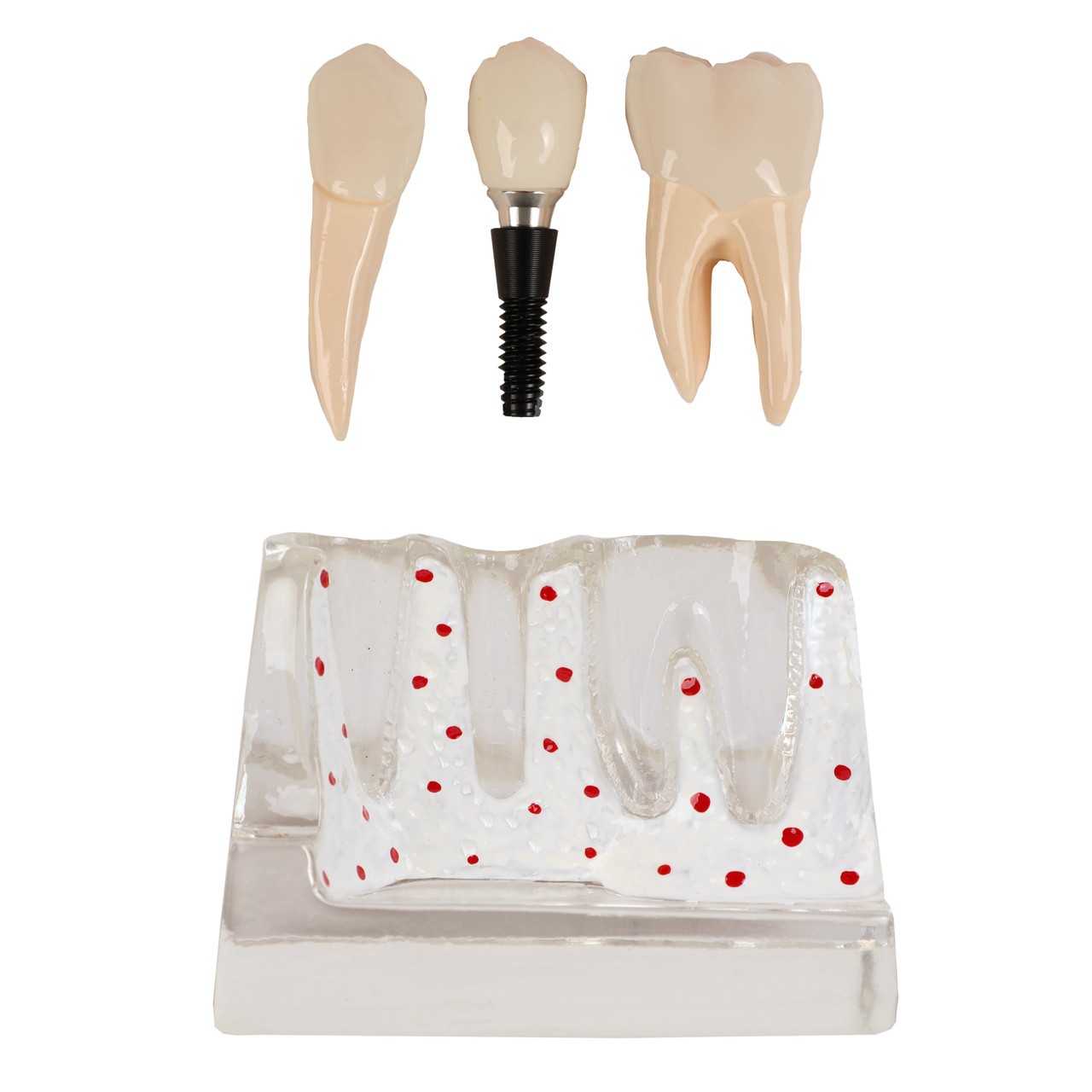 Axis Scientific Enlarged Transparent Dental Implant Anatomy Model