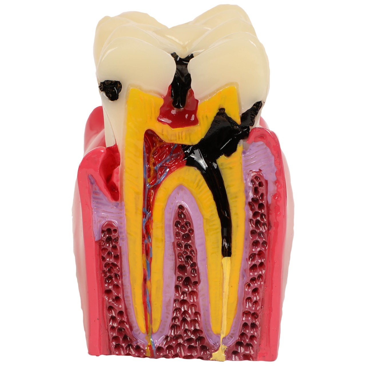 Axis Scientific Decayed Teeth Comparison Anatomy Model, 6x Life-Size