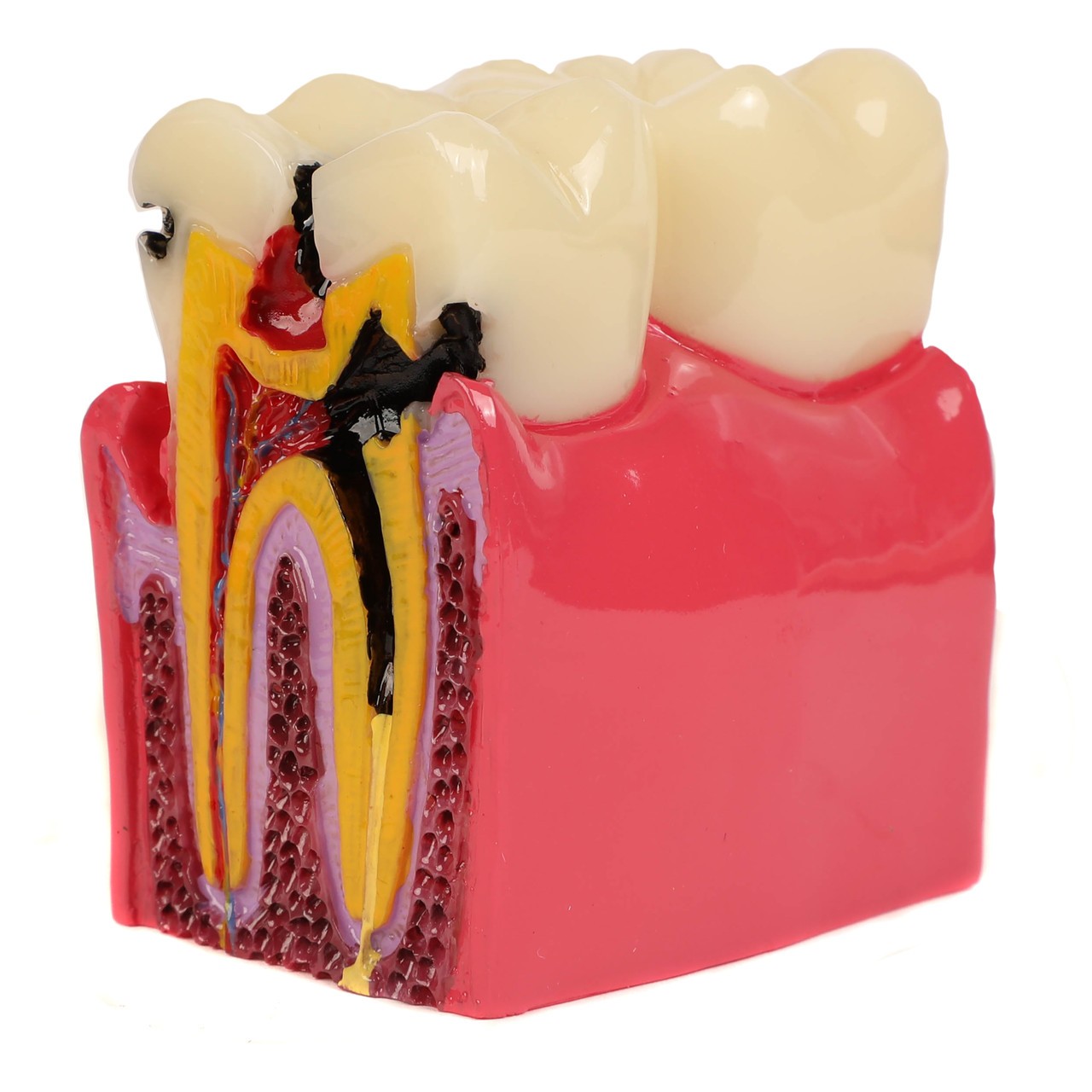 Axis Scientific Decayed Teeth Comparison Anatomy Model, 6x Life-Size