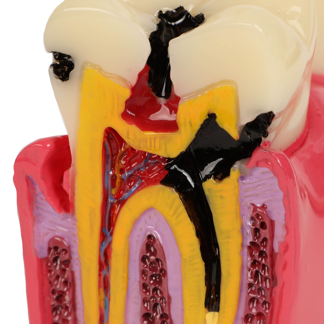 Axis Scientific Decayed Teeth Comparison Anatomy Model, 6x Life-Size